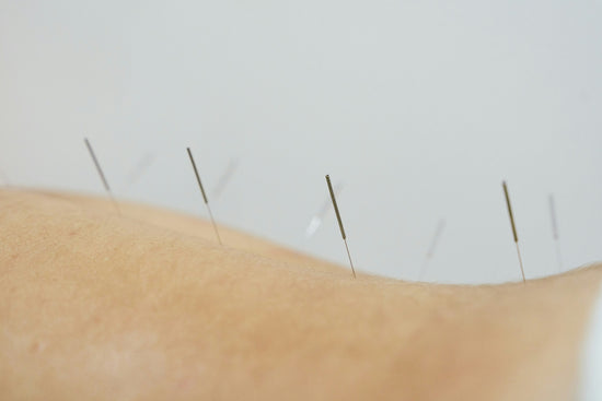 Fertility Acupuncture: Can It Really Help You Get Pregnant?